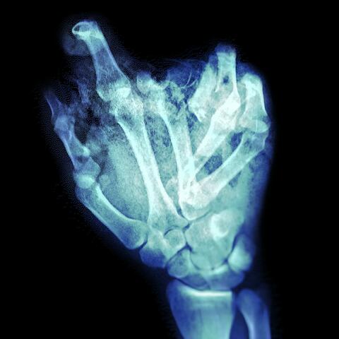 breaking the bones in my hands