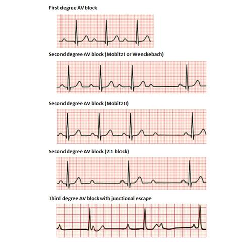 First Degree AV Block