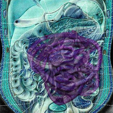 Ascariasis