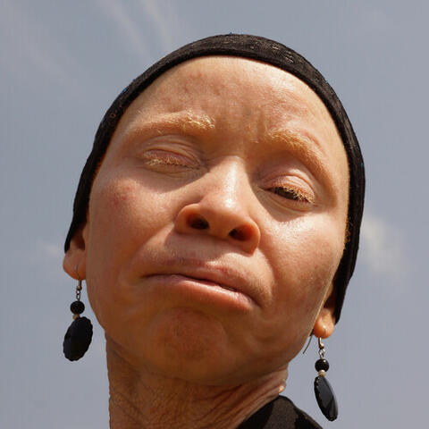 Tanzania Albinism Collective