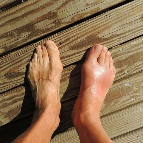 Gout Causes and Treatment