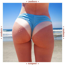 Sunburn