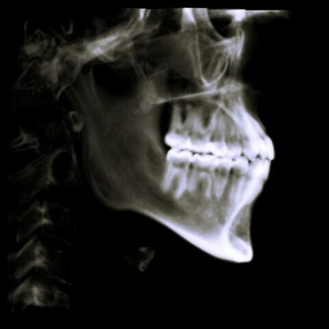 Somnambulism