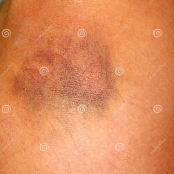 bruise