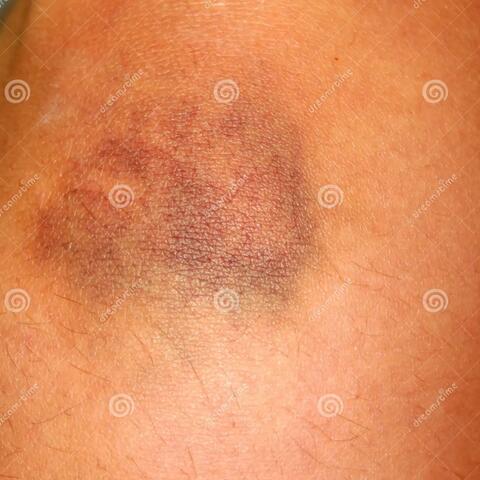 bruise