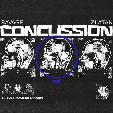 Concussion