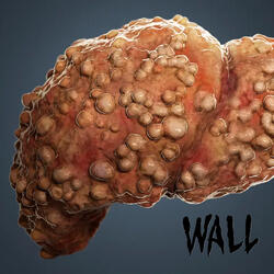 Cirrhosis