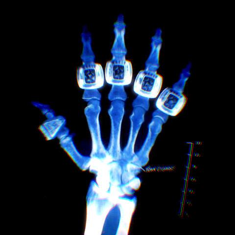 Torn Ligament