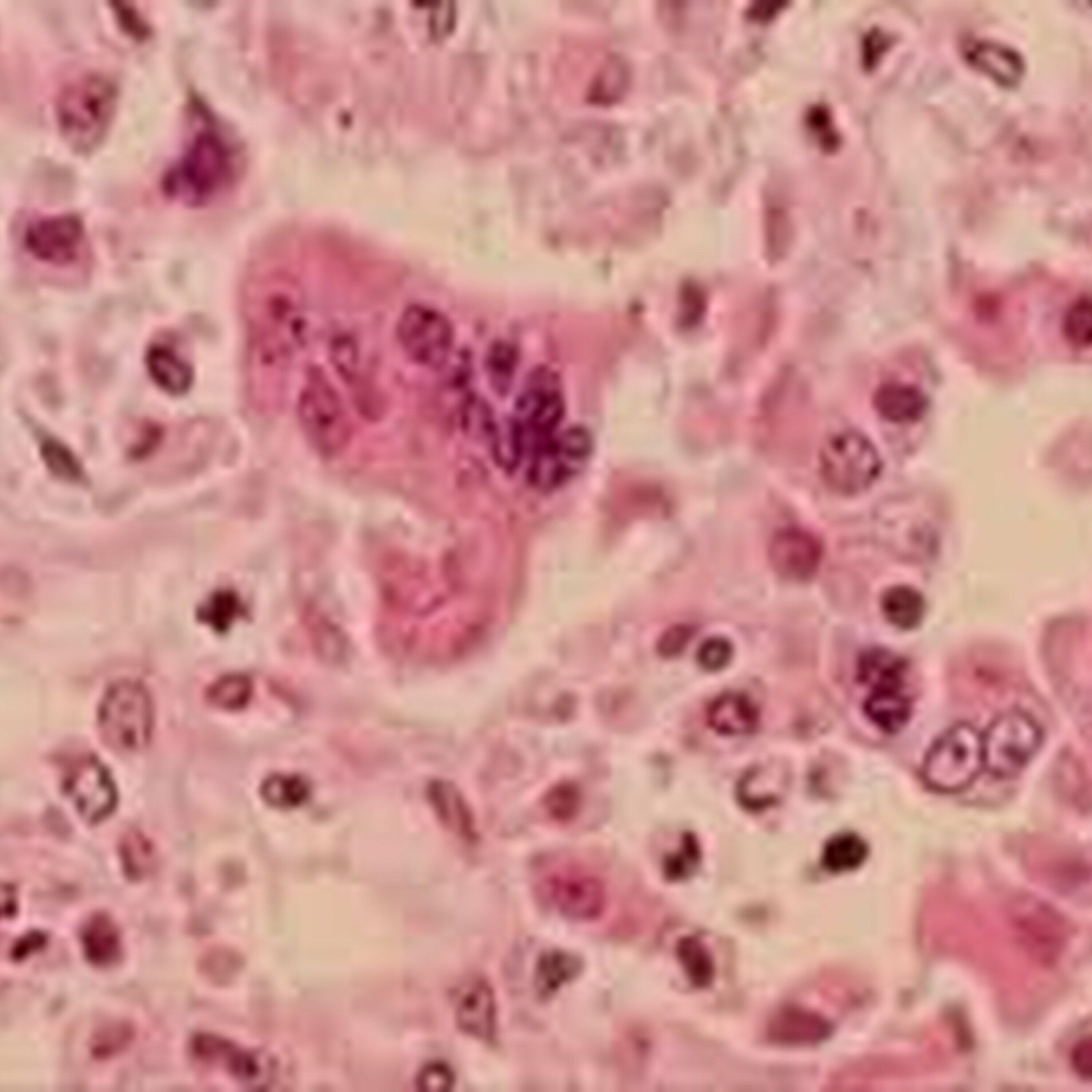 CFRA Live - Calls to get vaccinated grow as EOHU reports 2 new cases of the measles virus