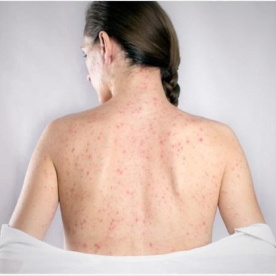 CDC Warns