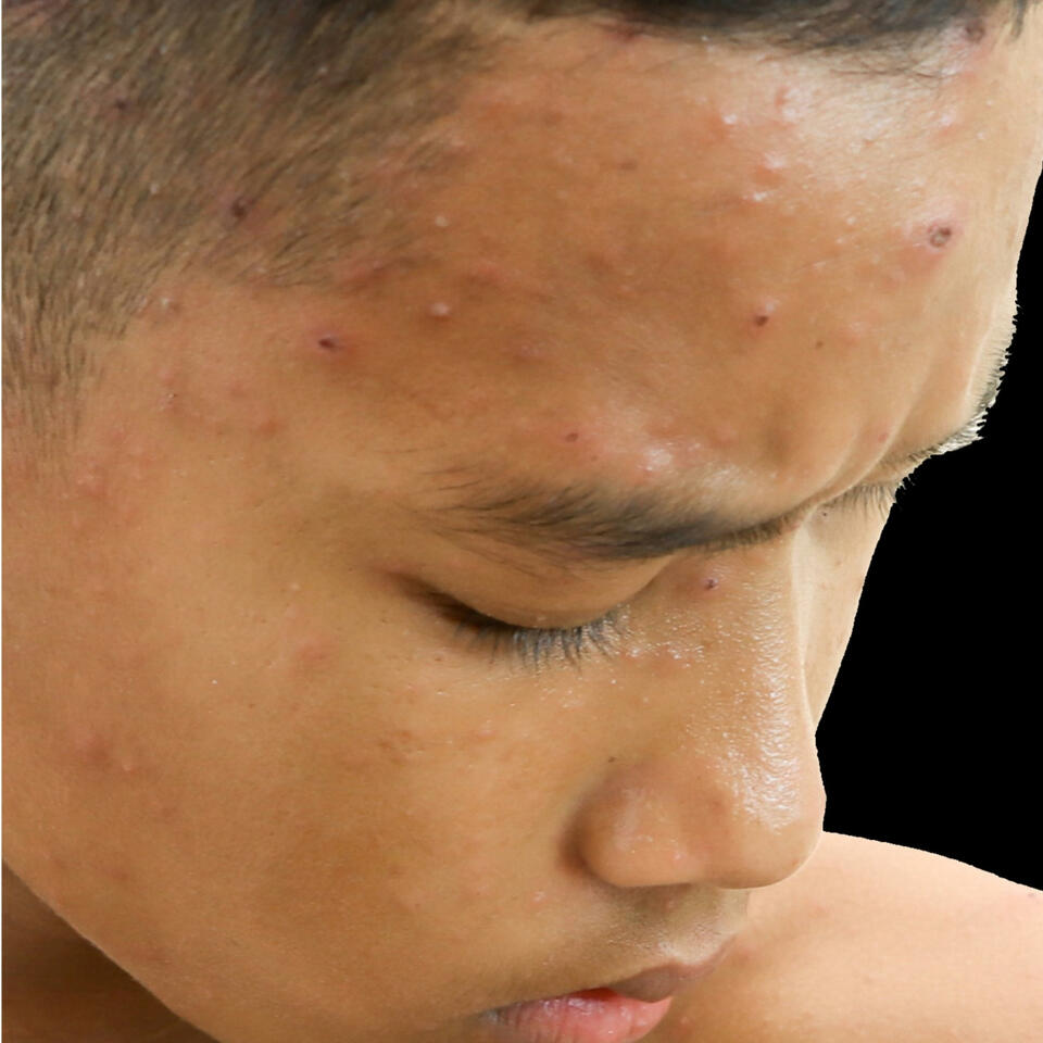 New Strategies and Best Practices in the Management of Pediatric Facial and Truncal Acne