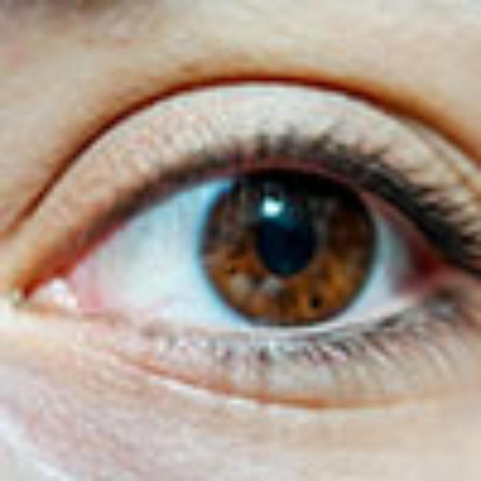 Managing Patients With Neurotrophic Keratitis (NK)