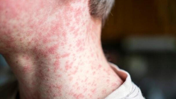 “We dodged a bullet”: Cairns measles outbreak over